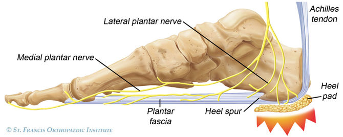 Heel & arch pain (Plantar Fasciitis)