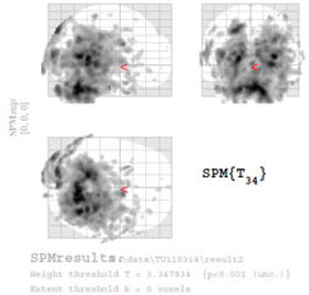 脳活整体によってもたらされる血流増加を示すfMRI