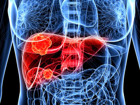 ¿Cuál es la diferencia entre un sarcoma y un carcinoma?