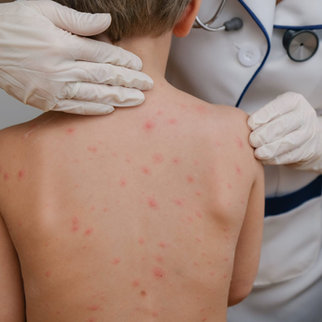 Honduras actualiza medidas sanitarias para viajeros ante riesgo de sarampión