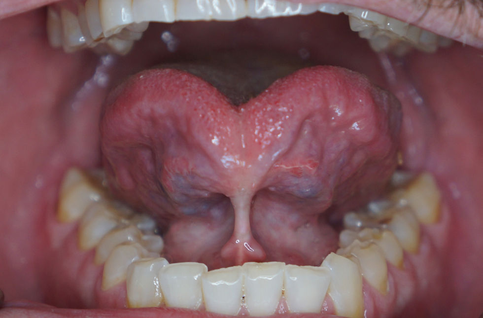 Tongue-Tie and Sleep: The Hidden Cause of Snoring