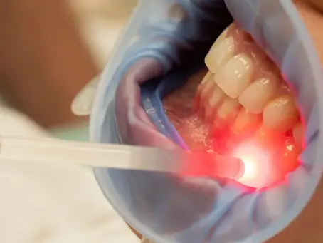 Photobiomodulation in Dentistry: How Light Accelerates Healing