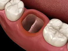 tooth-extraction.webp