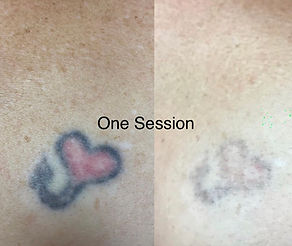 TATTOO REMOVAL 1 SESSION.jpeg