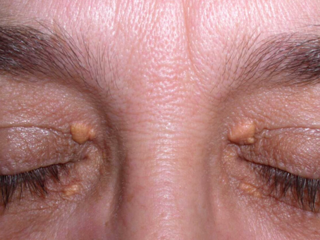 What are xanthelasma and how can they be treated?