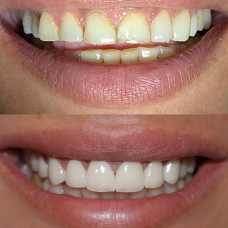 Before and after creating harmonious smile design