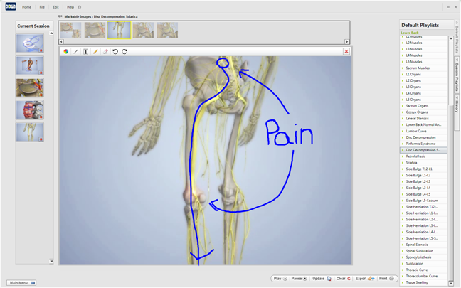 sciatica pain due to bulging disc