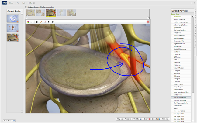 bulging disc example