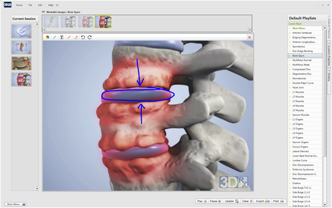 Compressed disc with bone spurs