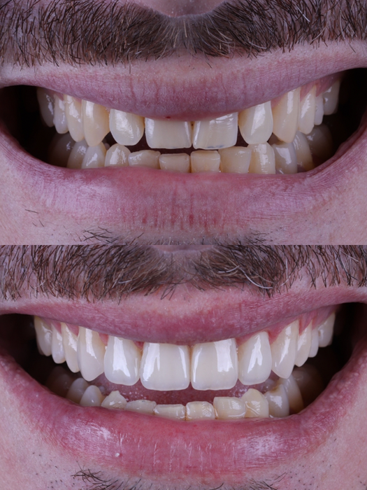 Trabalho de Resinas Compostas