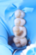 Foto de um dos procedimentos mostrando a prevenção e adequação do meio bucal