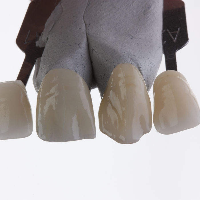 Coroas e Facetas de Silicato