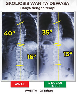 Terapi Skoliosis Jakarta, skoliosis dewasa 40 derajat ke 35 derajat hanya dengan terapi, skoliosis kurva S, skoliosis 40 derajat, skoliosis 16 derajat, turun derajatnya