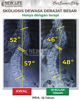 Terapi skoliosis Jakarta, Skoliosis pria dewasa 16 tahun, sembuh skoliosis tanpa operasi, skoliosis 57 derajat jadi 48 derajat, Pratama Rizky