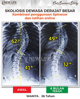 Terapi skoliosis Jakarta, Skoliosis wanita 26 tahun, sembuh skoliosis tanpa operasi, skoliosis 41 derajat jadi 32 derajat, Pascahana Lintang