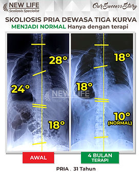 Terapi dan Latihan Skoliosis Jakarta, terapi skoliosis jakarta laki-laki dewasa sembuh, skoliosis 3 kurva sembuh, Christian Kasim.jpg