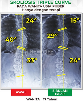 Terapi dan Latihan Skoliosis Jakarta, Terapi dan Latihan Skoliosis Derajat Besar, menuju normal, menuju sembuh skoliosis