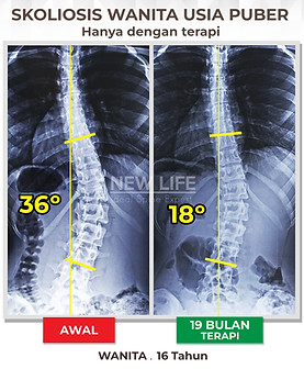 Terapi skoliosis Jakarta, Skoliosis perempuan, skoliosis wanita, sembuh skoliosis hanya dengan terapi, skoliosis 36 derajat jadi 18 derajat, penanganan skoliosis