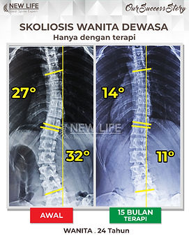 Terapi skoliosis Jakarta, Skoliosis wanita, skoliosis wanita dewasa 24 tahun, sembuh skoliosis tanpa operasi, skoliosis 32 derajat jadi 11 derajat, Wilnie.jpg