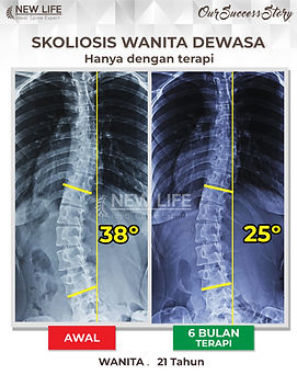 Terapi skoliosis Jakarta, Skoliosis perempuan, skoliosis wanita dewasa, sembuh skoliosis hanya dengan terapi, skoliosis 38 derajat jadi 25 derajat, Ruth Intan.jpg