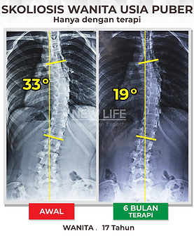 Terapi skoliosis Jakarta, Skoliosis perempuan, skoliosis wanita, sembuh skoliosis hanya dengan terapi, skoliosis 33 derajat jadi 19 derajat, penanganan skoliosis