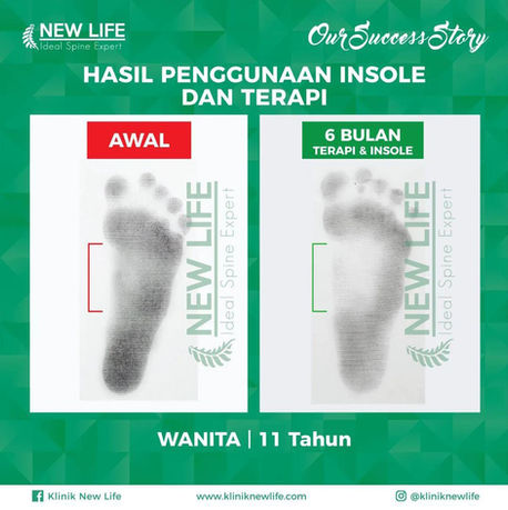 Terapi kaki bebek