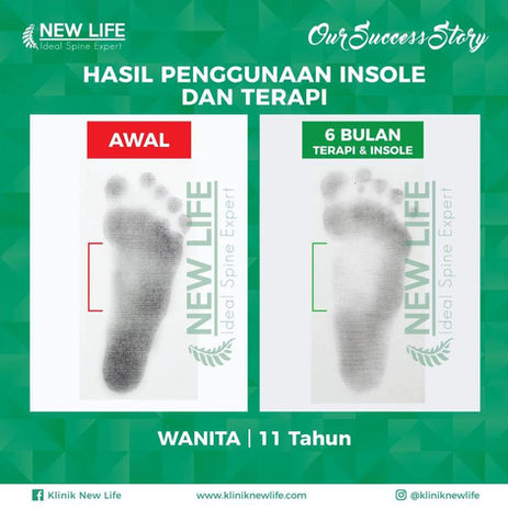 Terapi Kaki Bebek | Terapi Flat Foot