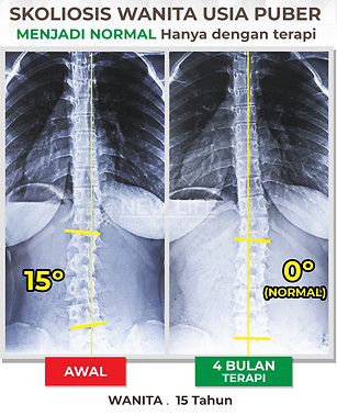 Terapi skoliosis Jakarta, Skoliosis perempuan, skoliosis wanita, sembuh skoliosis hanya dengan terapi, skoliosis 15 derajat jadi 0 derajat, normal