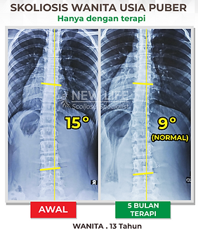 Terapi skoliosis Jakarta, Skoliosis wanita 13 tahun, sembuh skoliosis tanpa operasi, skoliosis 15 derajat jadi 9 derajat, Anggi Tsamara
