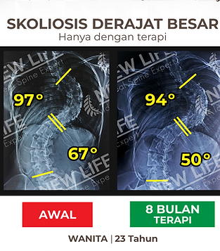 Terapi dan Latihan Skoliosis Jakarta, terapi skoliosis jakarta pria dewasa sembuh, normal skoliosis, turun hanya dengan terapi