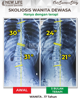 Terapi skoliosis Jakarta, skoliosis wanita remaja 17 tahun, sembuh skoliosis tanpa operasi, skoliosis 31 derajat jadi 21 derajat, Rajwa Syahida
