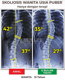 Terapi Skoliosis Jakarta, Terapi Skoliosis Remaja Wanita, 42 derajat, menuju normal, menuju sembuh skoliosis, skoliosis 42 derajat dan 37 derajat, 35 derajat, dan 27 derajat. skoliosis puber