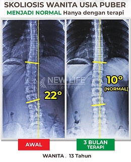 Terapi dan latihan skoliosis usia puber, skoliosis remaja, skoliosis wanita, sembuh skoliosis