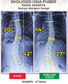 Terapi skoliosis Jakarta, Skoliosis perempuan, skoliosis wanita, sembuh skoliosis hanya dengan terapi, skoliosis 20 derajat jadi 14 derajat, 42 derajat jadi 27 derajat