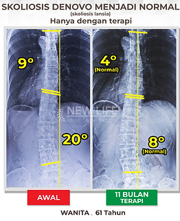 Terapi dan latihan Skoliosis usia lanjut (Skoliosis de novo), skoliosis wanita, menuju sembuh skolio