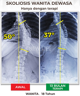 Terapi skolisis jakarta, latihan skoliosis jakarta, skoliosis wanita dewasa, mulai menjadi normal