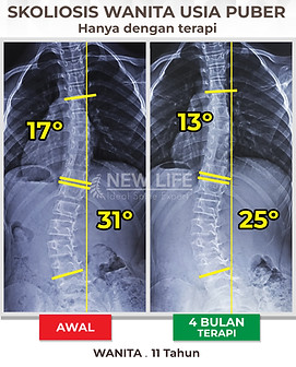 Terapi skoliosis Jakarta, Skoliosis perempuan, skoliosis wanita, sembuh skoliosis hanya dengan terapi, skoliosis 17 derajat jadi 13 derajat, 31 derajat jadi 25 derajat