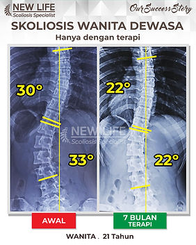 Terapi skoliosis Jakarta, Skoliosis perempuan, skoliosis wanita dewasa, sembuh skoliosis hanya dengan terapi, skoliosis 33 derajat jadi 22 derajat