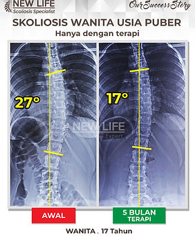 Terapi skoliosis Jakarta, Skoliosis perempuan, skoliosis wanita usia puber, sembuh skoliosis hanya dengan terapi, skoliosis 27 derajat jadi 17 derajat, Raina Rachel