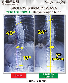 Terapi dan Latihan Skoliosis Jakarta, terapi skoliosis jakarta, pria dewasa sembuh, normal skoliosis, 40 derajat ke 24 derajat, 17 derajat ke 7 derajat, Made Wetanjpg