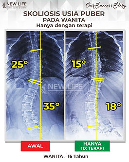 Terapi skoliosis Jakarta, Skoliosis perempuan, skoliosis wanita puber 16 tahun, sembuh skoliosis hanya dengan terapi, skoliosis 35 derajat jadi 18 derajat, Althaharah Sakurawikara.jpg