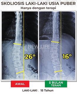 Terapi Skoliosis Jakarta, Terapi Skoliosis Remaja Wanita, 26 derajat, menuju normal, menuju sembuh skoliosis, skoliosis 26 derajat menjadi dan 16 derajat.