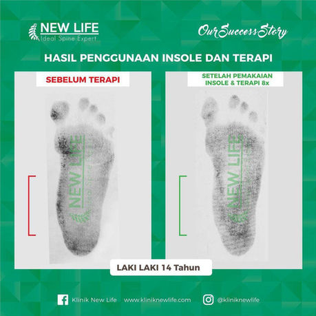 Terapi kaki bebek