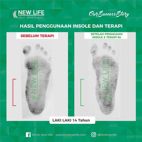 Terapi Kaki Bebek | Terapi Flat Foot