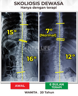 Terapi dan latihan skoliosis usia puber, skoliosis remaja, skoliosis wanita, sembuh skoliosis