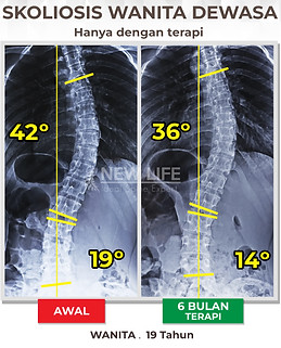 Terapi skolisis jakarta, latihan skoliosis jakarta, skoliosis wanita dewasa, mulai menjadi normal