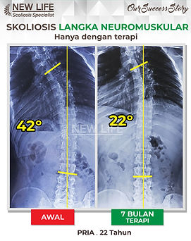 Terapi skoliosis Jakarta, Skoliosis pria 22 tahun, sembuh skoliosis tanpa operasi, skoliosis 42 derajat jadi 22 derajat, Rifaldo