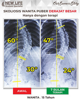 Terapi skoliosis Jakarta, Skoliosis wanita remaja 15 tahun, sembuh skoliosis tanpa operasi, skoliosis 60 derajat jadi 30 derajat, Moza