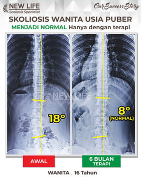 Terapi skoliosis Jakarta, Skoliosis perempuan, skoliosis wanita usia puber, sembuh skoliosis hanya dengan terapi, skoliosis 18 derajat jadi 8 derajat, normal