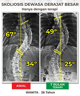 Terapi dan Latihan Skoliosis Jakarta, Terapi dan Latihan Skoliosis Derajat Besar, menuju normal, menuju sembuh skoliosis, Skoliosis dewasa